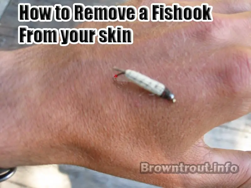 fish hook removal from skin